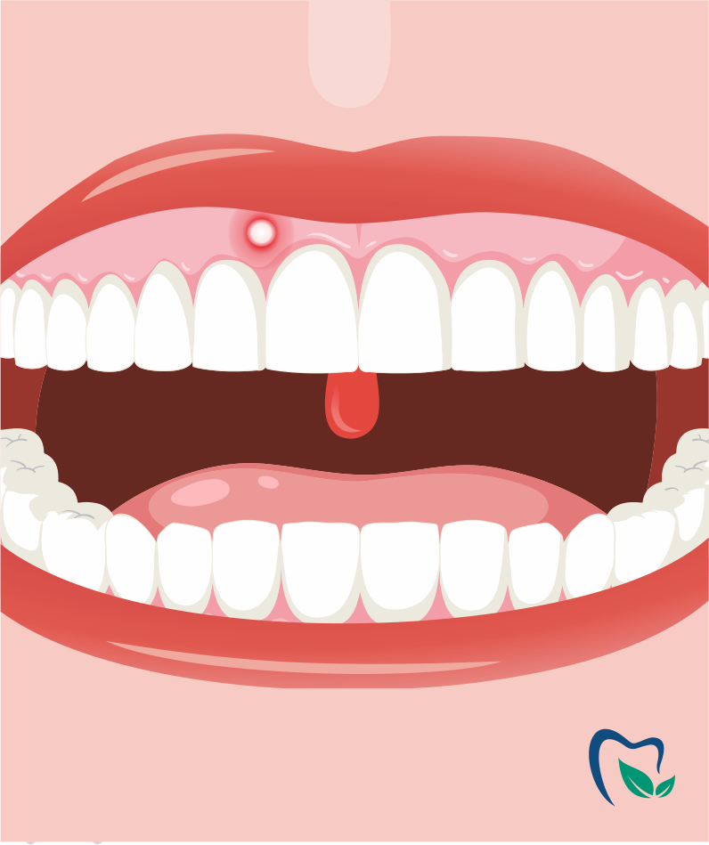 Лейкоплакия полости рта: причины, типы и лечение | Colgate®